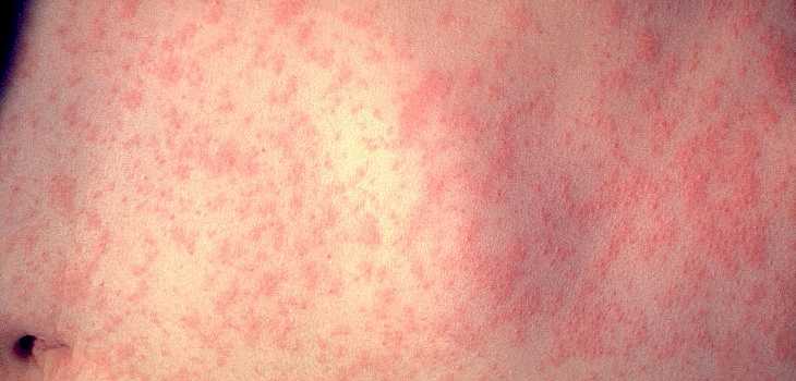 Barron Co. Residents Encouraged to Get Vaccinated After Measles Outbreak in MN