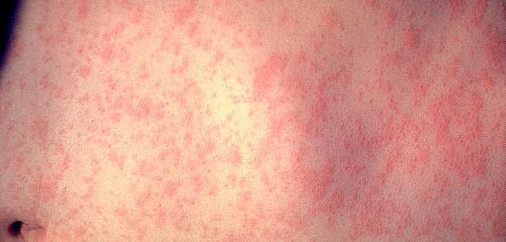Measles - More Than Just A Rash