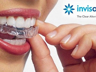 Ask the Dentist: Can My Teeth be Straightened Without Metal Braces? Article Image