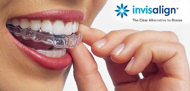 Ask the Dentist: 'Do You Have Any Before & After Pictures of Smiles That Used Invisalign?'